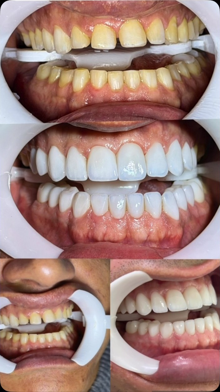 Dentes alinhados e claros